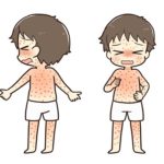 風疹の症状、子供の熱での注意点